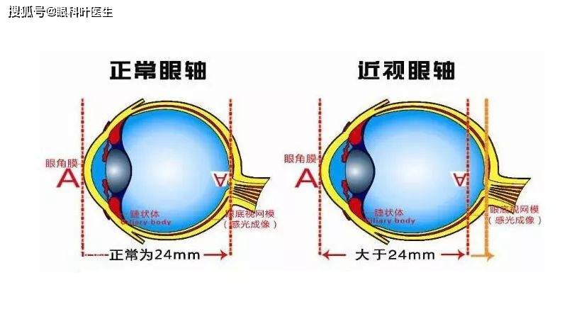 家长是高度近视,孩子一定会近视吗?