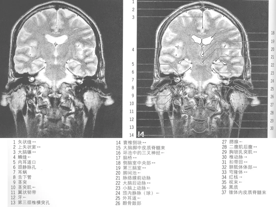 影像基础mri颅脑冠状位解剖图谱