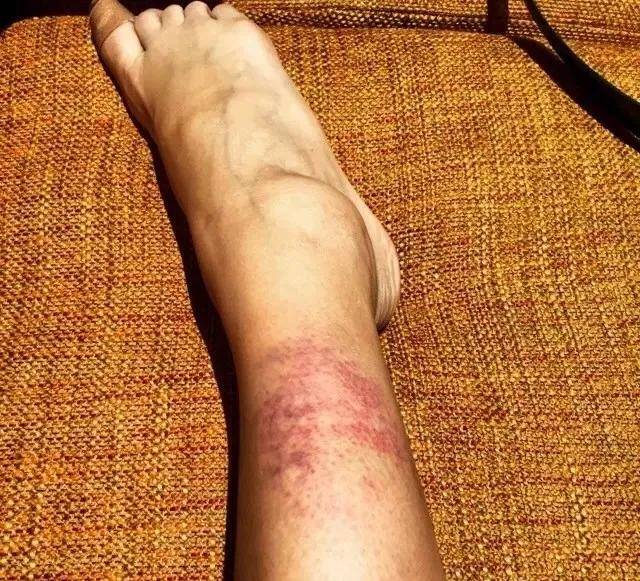 受伤|张蓝心拍戏头部受伤，头裹纱布满身血迹，为赶进度拒绝缝针