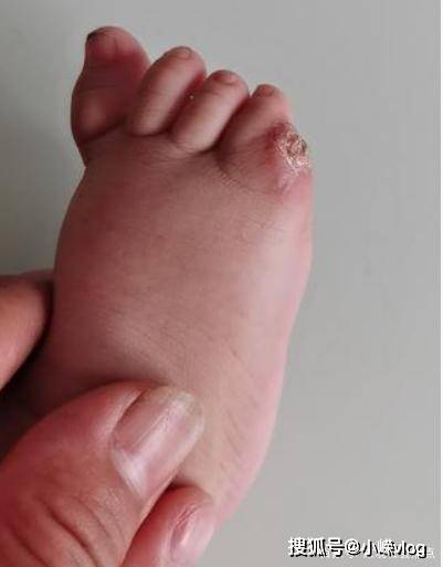 医生私自收钱给幼儿做手术，结果手术失败，结局导致幼儿被截肢