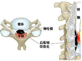 acaf治疗颈椎后纵韧带骨化新技术