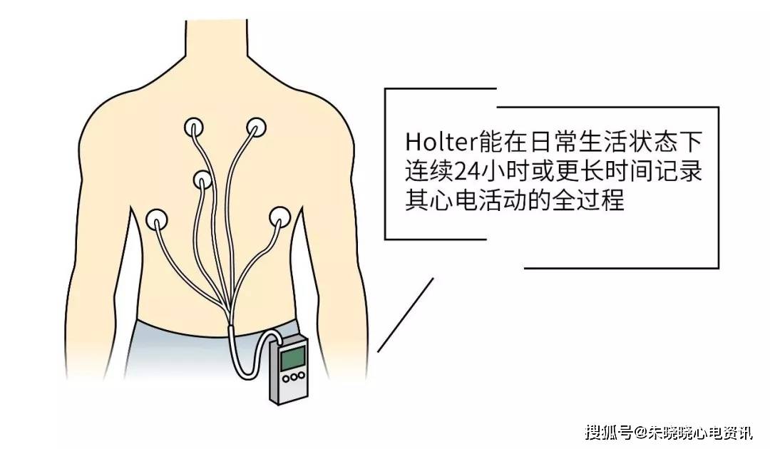 如果是"偶发"早搏,且没有症状,这时又可以让holter来帮忙查一下,一般