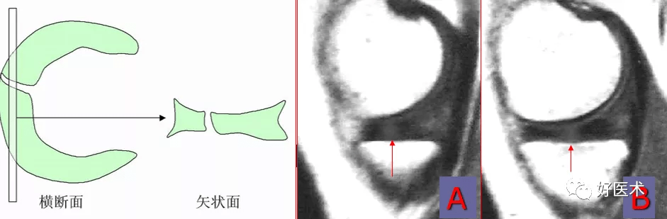 半月板斜向撕裂介于横向和纵向撕裂,其撕裂线从半月板游离缘斜向弯入