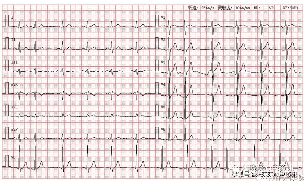 其前无p波,其后代偿完全,形态宽大畸形,由此可知其为室性早搏二联律