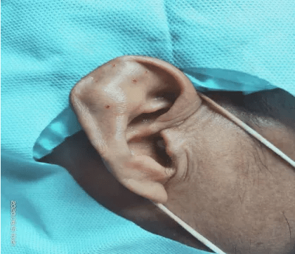 确诊刘先生右耳廓的"小枕头"其实是耳鼻喉科最常见的耳廓假性囊肿