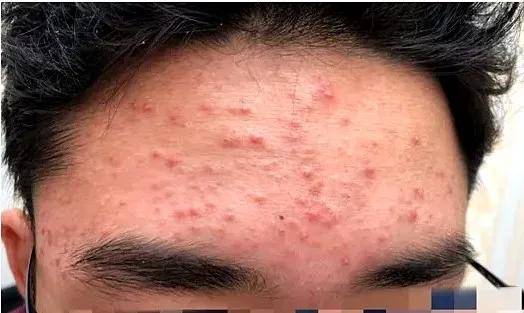 前者多由细菌或真菌感染引起,而后者属于美容皮肤科的常见病,大家一定