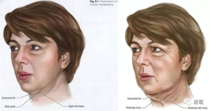 张脸|当年艳绝四方让张雨绮都甘心做配,可现在这张脸说崩就崩了...