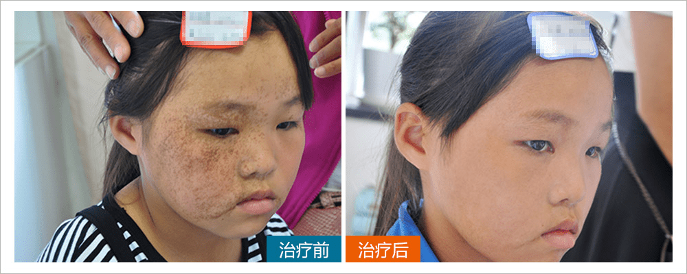 上海长江胎记医院肖萍科普:雀斑样痣复发问题_手机搜狐网
