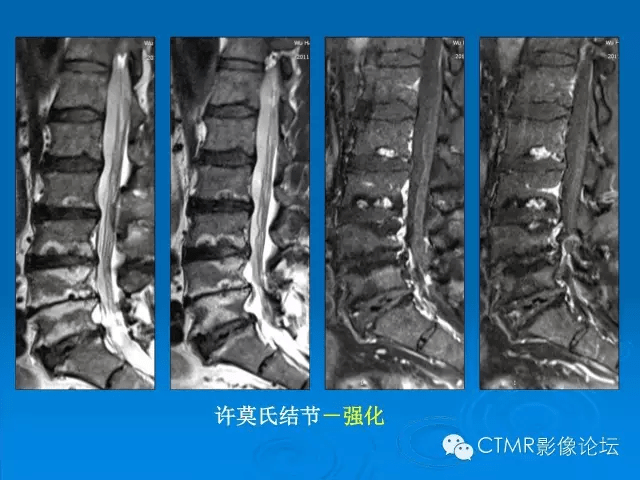 椎间盘退变某些mr征象的再认识