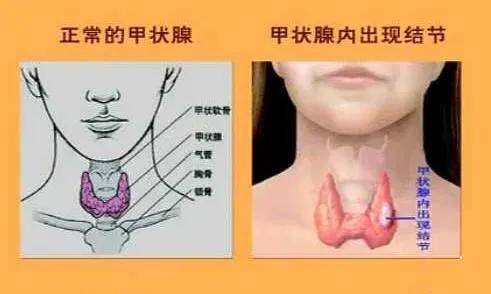 甲状腺结节是怎么分级的?达到几级就是癌症呢?