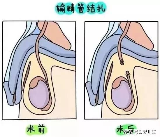 因为男性结扎手术,风险更低,创伤更小,效果更好,恢复更快.