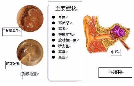 中耳炎高发于儿童不容忽视