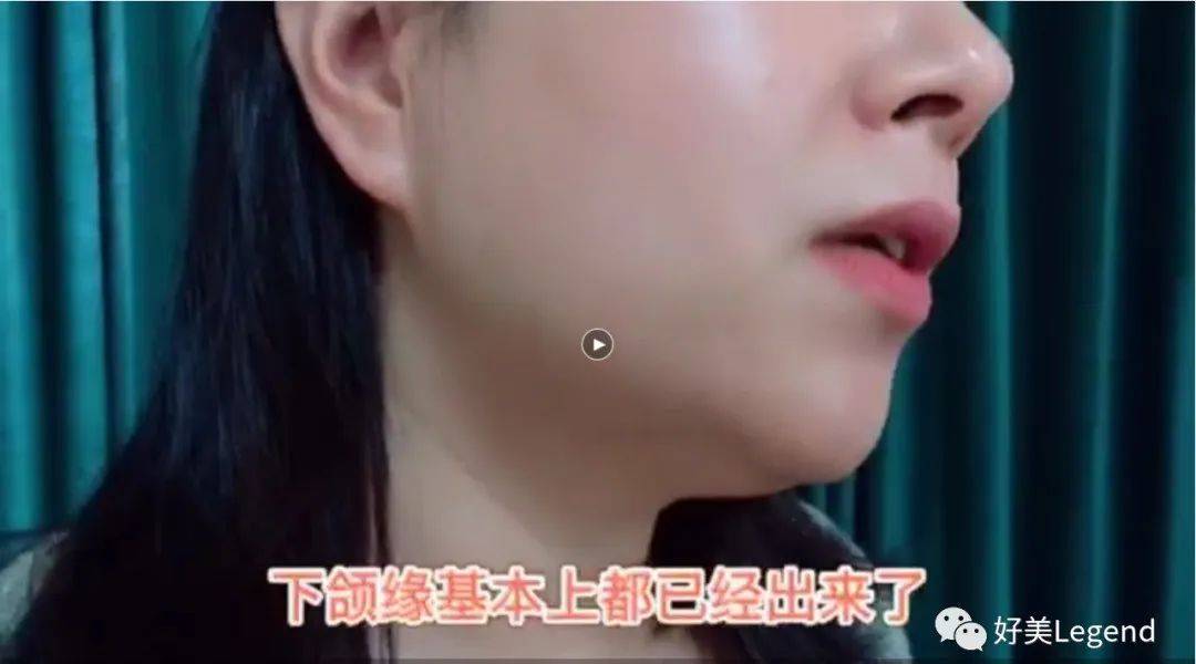 连喜艳|这回我可以大声的说：双下巴，再见！