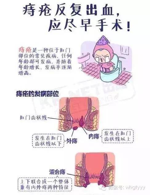 痔疮出血 到底该不该手术?