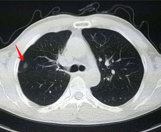 肺结节不是指病灶兄质