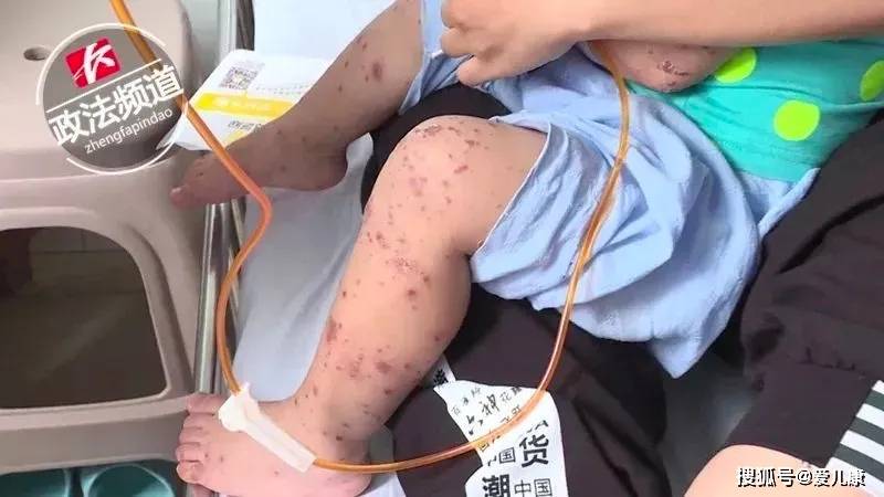 又一个传染极强的病毒正高发！家有5岁以下儿童注意了…