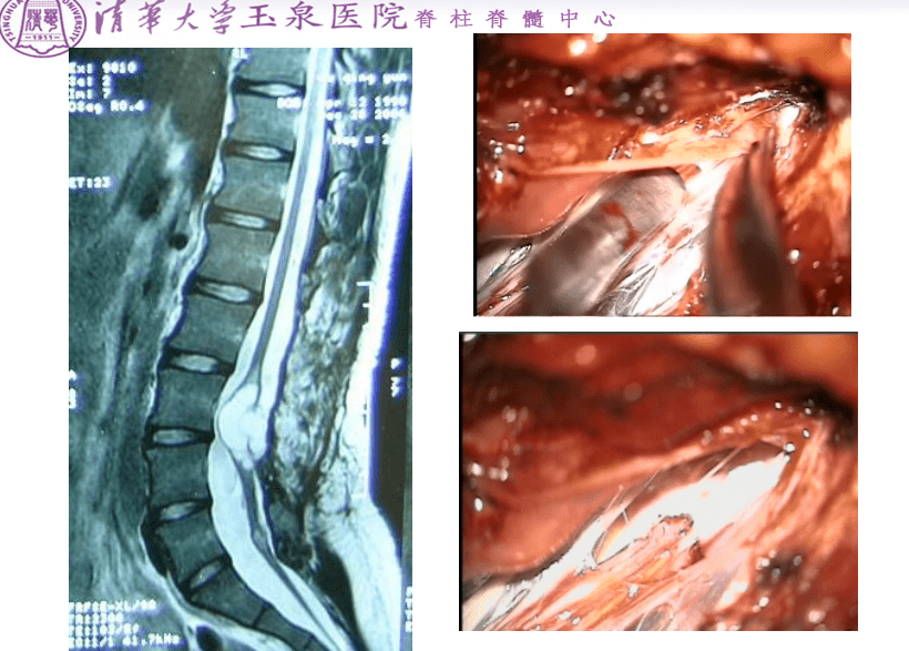 您知道什么是脊髓肠源性囊肿吗?