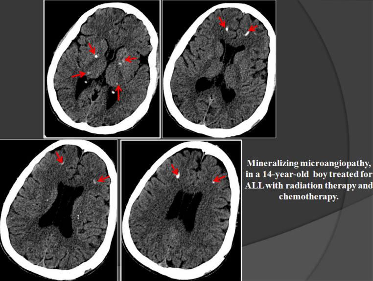 矿化性微血管病,通常在放化疗 2 年后的患者,钙化位于基底节,丘脑和
