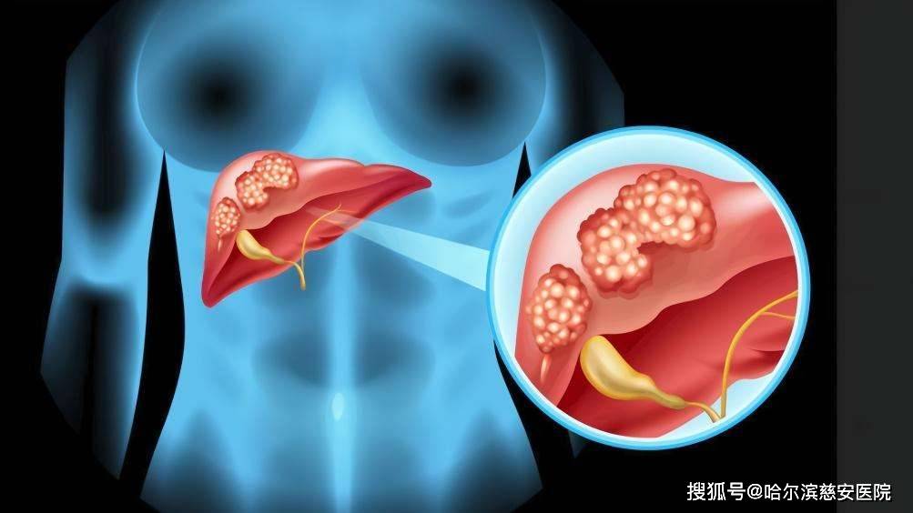 【肝炎】小便深黄,大便浅白,你可能得了淤胆型肝炎.