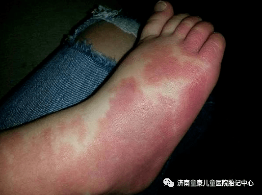 治疗|不要再对孩子胎记有误解了!济南童康儿童医院