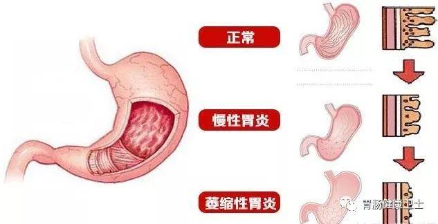 武汉胃肠医院专家带你了解胃癌发展的4个阶段从慢性萎缩性胃炎开始