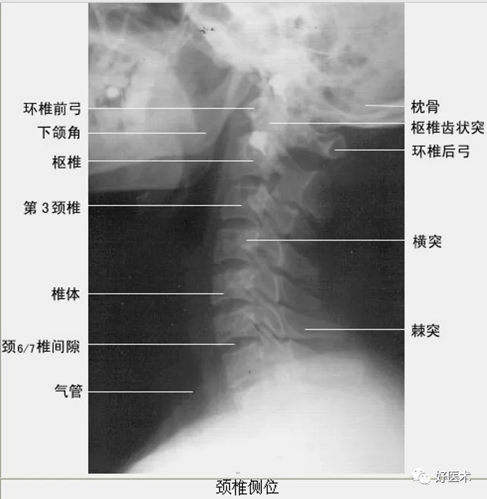 椎弓峡部:同一脊柱的上下关节突之间,椎弓板由椎弓根向后内方延续,并