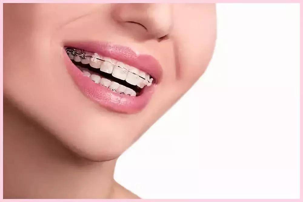 用于容纳固定正畸钢丝,传递矫治力到牙齿,从而达到牙齿矫正的目的