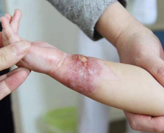 黄金时间|你知道该怎么做吗宝宝被烫伤奶奶抹大酱？2分钟的黄金时间