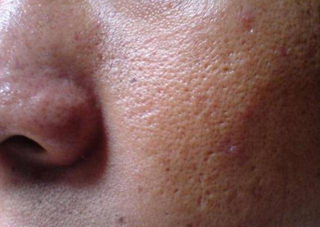 皮肤暗沉无光,痘痘反复长,常用一物洗脸,肌肤细腻有光泽