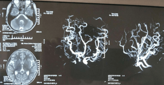 第二天,又做了头颅磁共振血管成像,提示疑似烟雾病.