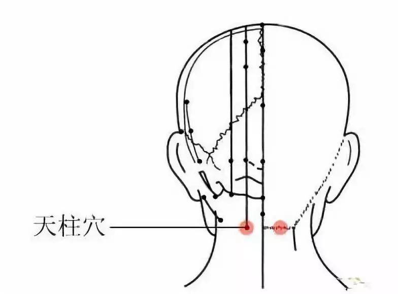 因为长期吹空调,颈椎受寒,气血瘀阻;长期久坐低 配穴:肢麻痛加手三里