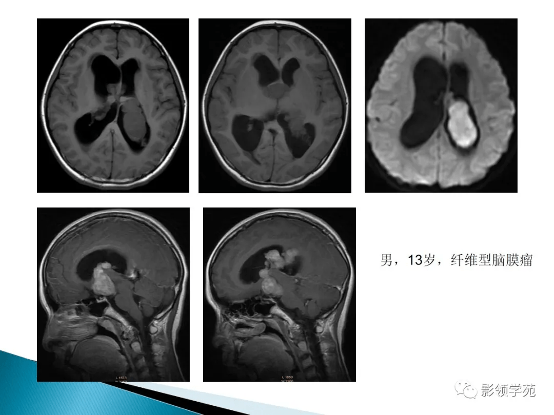 侧脑室肿瘤的影像诊断与鉴别