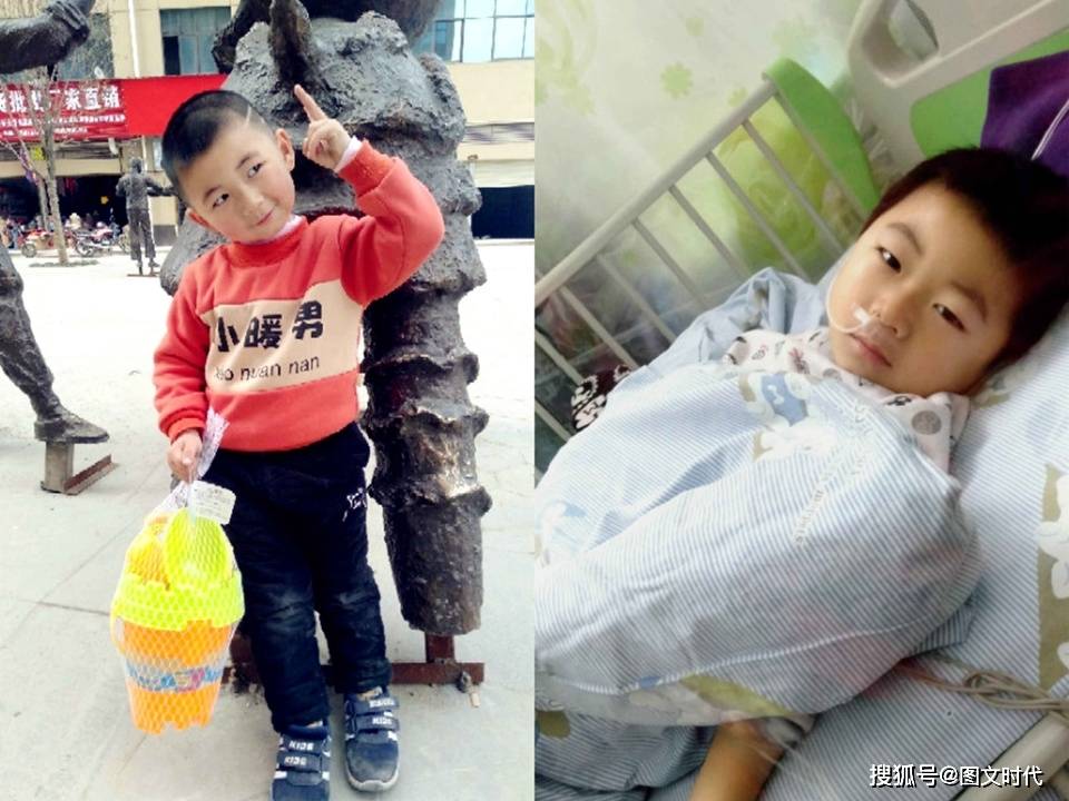 劫难|哥哥挺过来后被毁容,弟弟仍生死难料兄弟俩同在4岁遭劫难