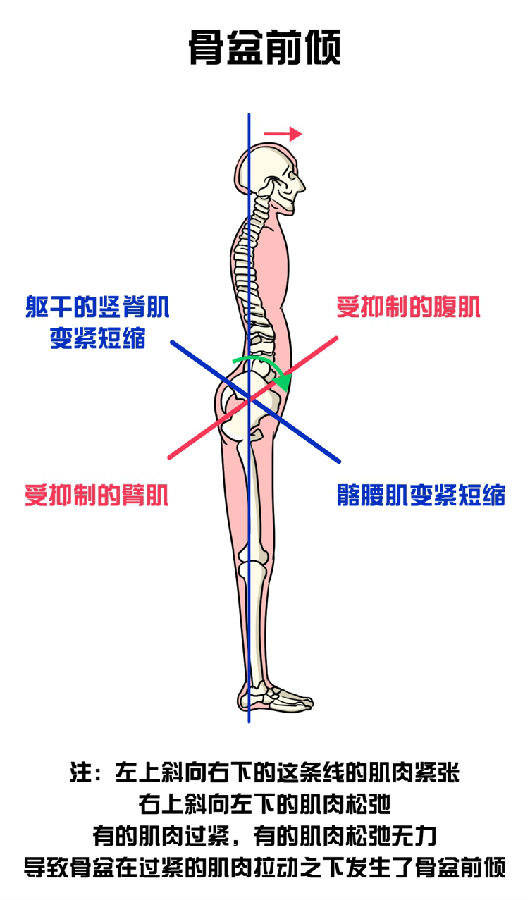 下交叉综合征