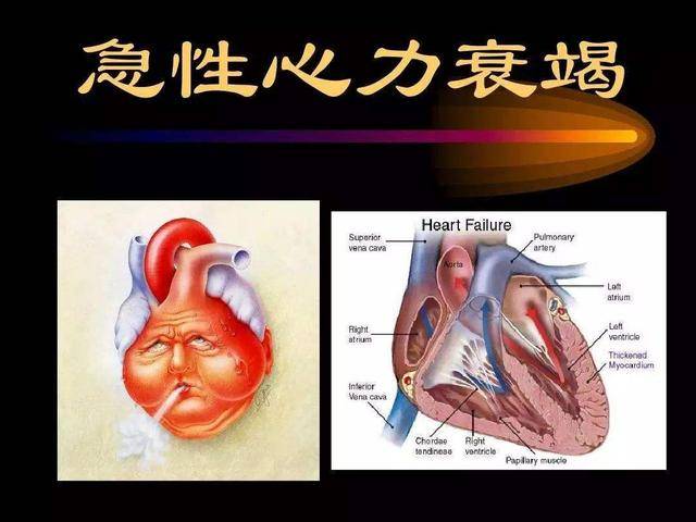 出现粉红色泡沫伴呼吸困难很快就会晕厥急性左心衰的故事