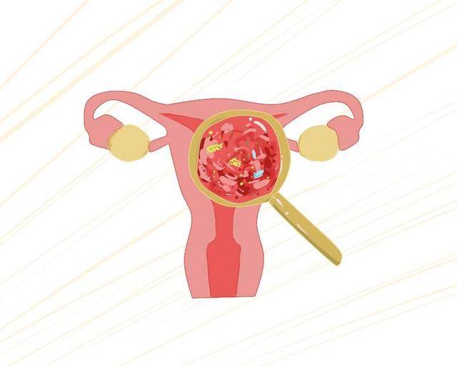 原创90后女子子宫取出71个肌瘤：出现3种现象，暗示子宫肌瘤来找事