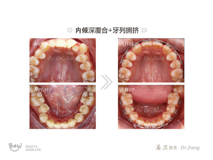 重庆牙齿矫正(正畸)【案例】—深覆合 牙列不齐 牙列拥挤