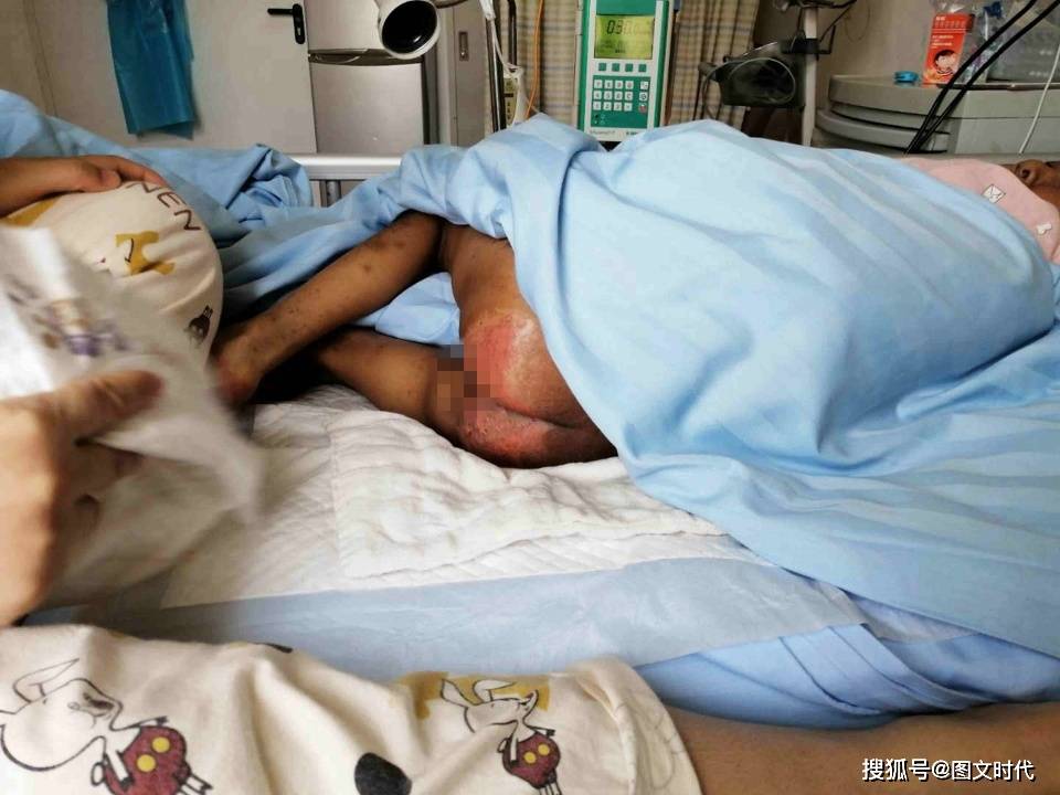 萱萱|4岁时随着一次喉咙的不舒服，噩梦降临了女童带着先天残缺出生