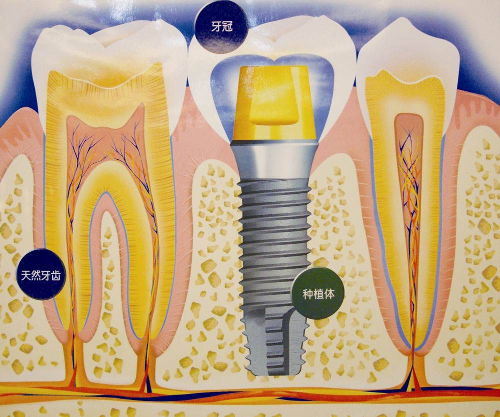 种植牙的这几个误区你踩雷了吗下