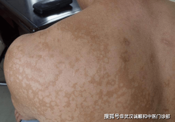 中医皮肤科胡爱玲中药配合熏蒸治花斑癣案例