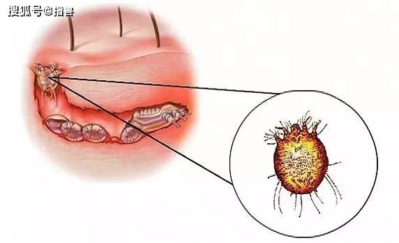 疥螨,痒螨,蠕形螨快速区别方法_手机搜狐网