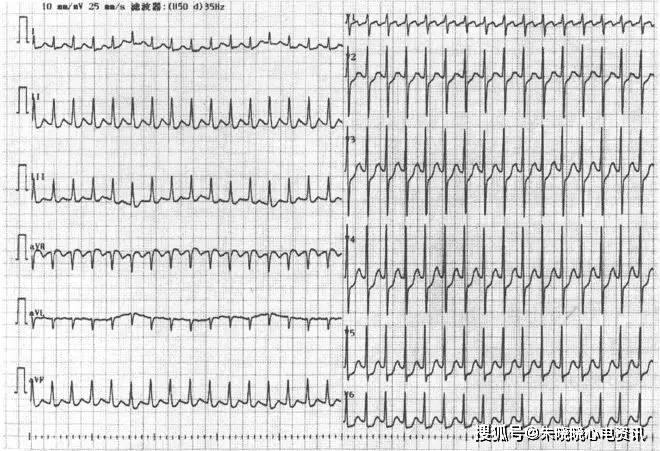 2,扑动波较规则,频率在240-430 bpm,1,房波规则,p波消失,代之以"f"波