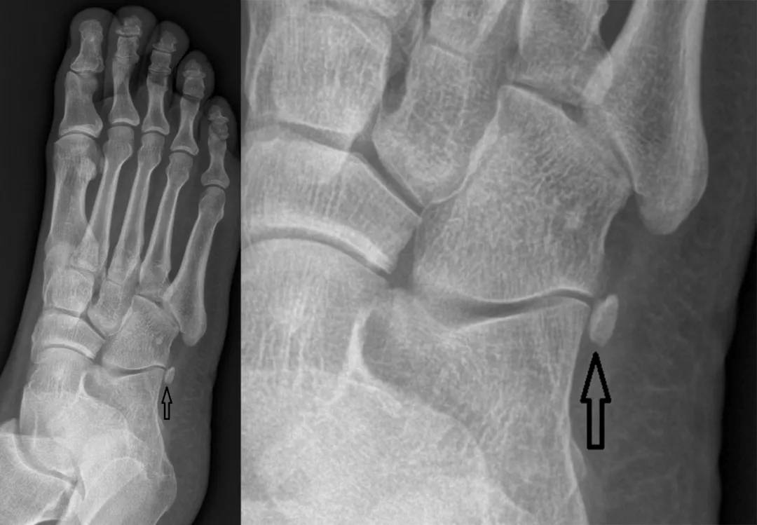 足踝撕脱性骨折与籽骨分不清楚?背下这张图再也不会漏