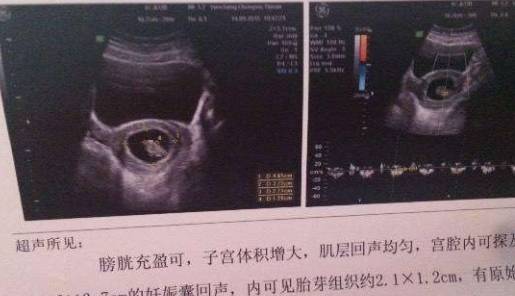产检b超单数值有没可能错 39b5aa29bd1e40d8b7d14fb1cb69745c.jpeg