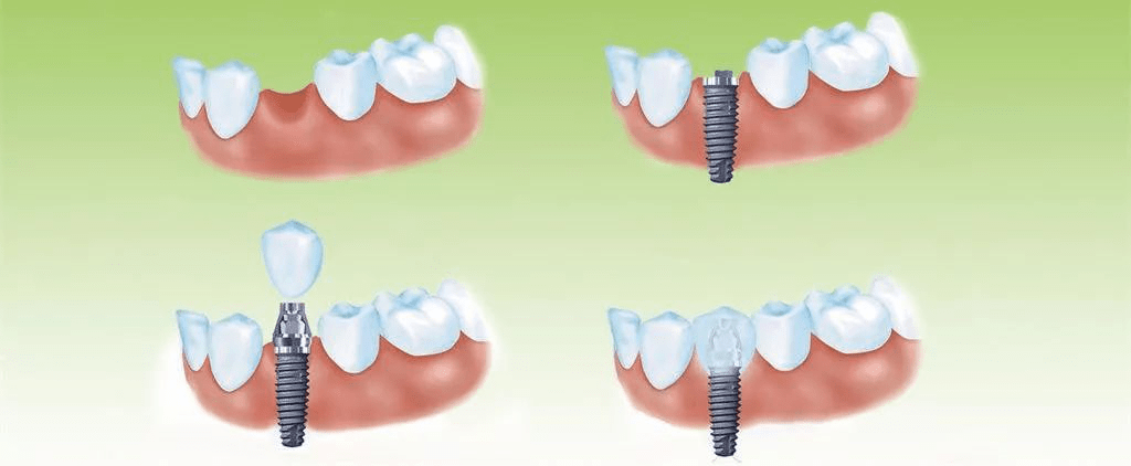 在缺牙区种一个牢固的种植体作为牙根,然后通过基台把牙冠连接到种植