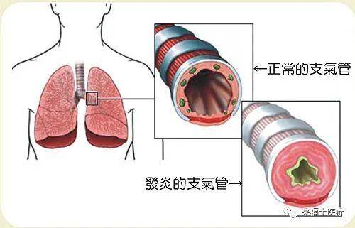 科普| 布地奈德雾化吸入的作用