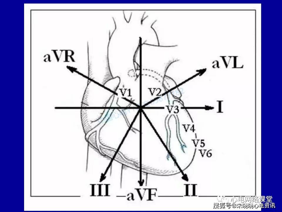 心电轴偏移在心电图和向量图上的对比分析