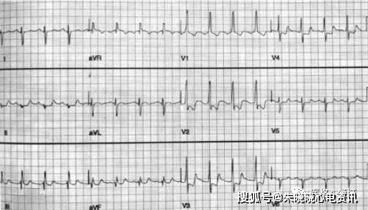 房室肥大心电图的判断技巧
