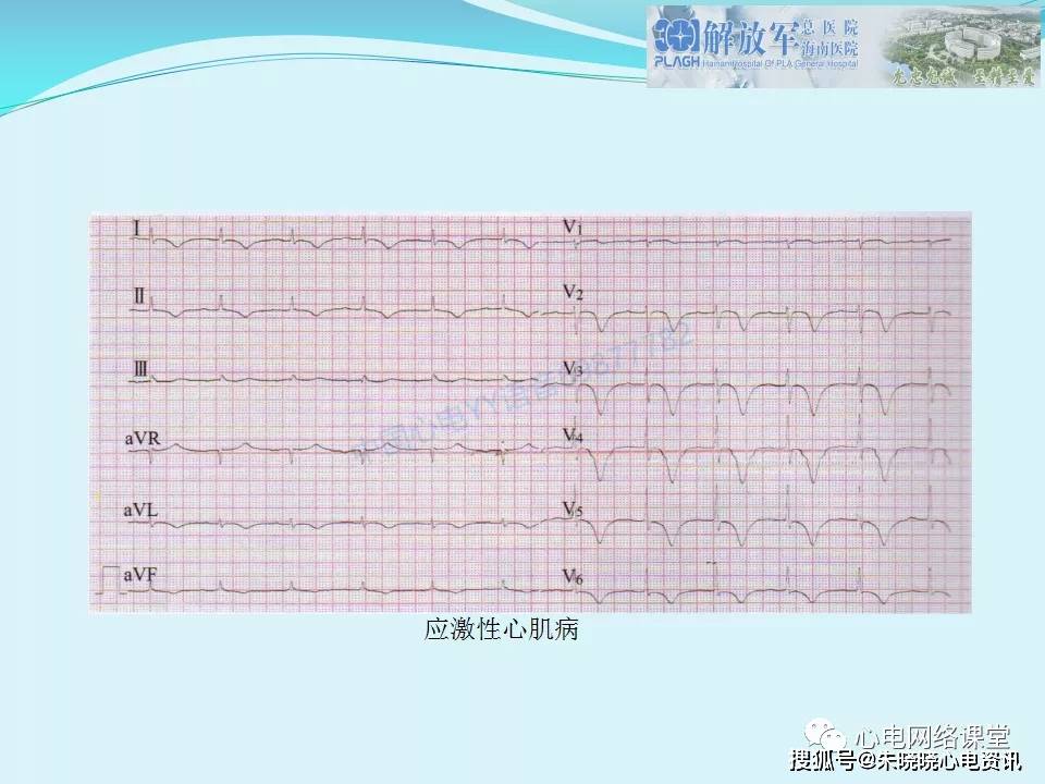 肺栓塞心电图表现及鉴别诊断