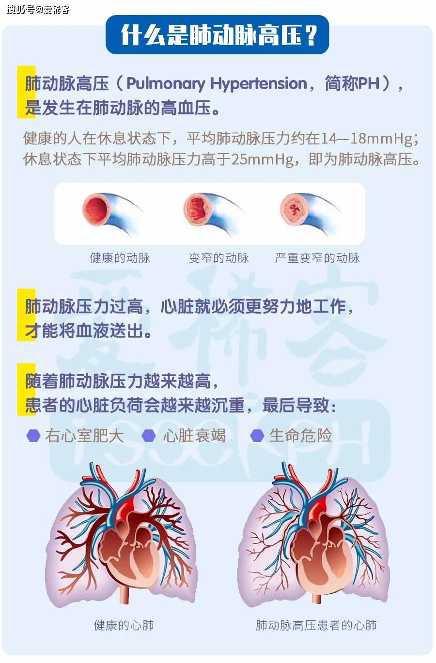 肺动脉人口图片_肺动脉高压图片